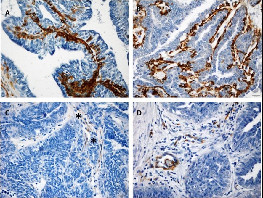Photomicrographs of papillary tumors in mammary gland of female dogs. (A) Papillary tumor with intense positive marking for the α-SMA within the papillae (bar = 10 μm). (B) Positive to moderate positive papillary tumor for α-SMA (bar = 10 μm). Papillary tumors with reduced (C) or scarce immunolabeling (*) (D) for the same antibody (bar = 10 μm). All samples were classified by HE analysis as papillary carcinoma. Complex of Peroxidase bound polymers.