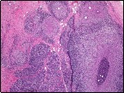 Granulomatous mastitis with the configuration of epitheloid cell granuloma and a lymphoid and plasma cell infiltrate9.