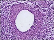 Granulomatous mastitis with a ductal circumscription of epitheloid cells, plasma cells, lymphocytes and neutrophils 18.