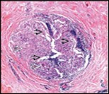 Granulomatous mastitis with articulated epitheloid cell granuloma, lymphocytic, plasma cell and neutrophilic infiltration10.