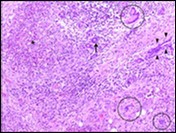Granulomatous mastitis with disseminated epitheloid cell granuloma, langhans giant cells, lymphocytic and plasma cell dispersal13.