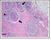 Granulomatous mastitis with numerous epitheloid cell granuloma, foreign body giant cells and a peripheral rimming with lymphocytes14.