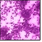 Granulomatous mastitis with scattered epitheloid cells, neutrophilic exudate and aggregates of epithelod cells15.
