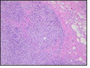 Granulomatous mastitis with circumscribed epitheloid cell granuloma, foreign body giant cells and a perimeter of lymphocytes 17.