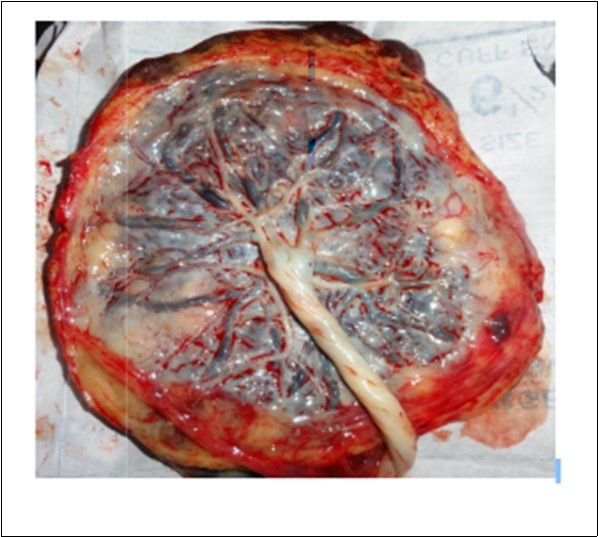 Round shape placenta (Photographed)