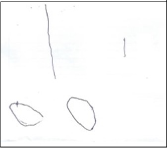 After treatment, the boy showed improvement in his ability to hold the pen as could draw a more straight line