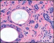 Desmoplastic trichoepithelioma demonstrating aggregates of basaloid cells with numerous keratinous horn cysts interspersed in an intensely fibrotic stroma 9.