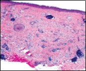 Desmoplastic trichoepithelioma delineating cords and nests of basaloid cells, few horn cysts and a circumscribing fibrotic stroma 9.