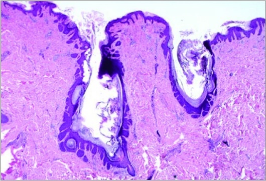Nevus comedonicus delineating dilated, plugged, follicular ostia, keratinous substance and a layering with a hyperkeratotic, stratified squamous epithelium[15.