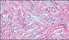 Soft tissue perineurioma with fascicles of bipolar neural cells with elongated cytoplasmic processes, wavy nuclei and an admixture of collagen fibres 11.