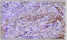 Soft tissue perineurioma demonstrating immune reactivity to epithelial membrane antigen EMA18.