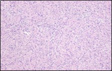 Soft tissue perineurioma with whorls of neural cells delineating spindle cells with bipolar cytoplasm and wavy nuclei and an admixture of collagen bundles 19.