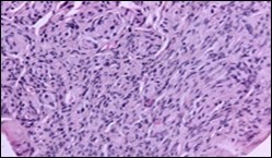 Soft tissue perineurioma with lamellar bundles of neural cells demonstrating elongated cytoplasmic processes, wavy, slender nuclei and admixed collagen fibres 12.