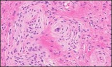 Soft tissue perineurioma with whorls and fascicles of neural cells displaying wavy nuclei, elongated cytoplasmic fibrils and intermingling of collagen fibres 13.