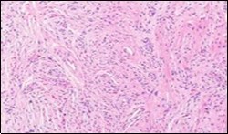 Soft tissue perineurioma composed of whorls and perivascular aggregates of neural cells with bipolar cytoplasmic processes, wavy, slender nuclei and commingled collagen fibres 13.