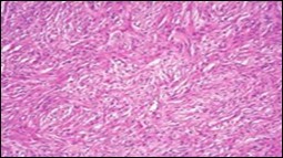 Soft tissue perineurioma /schwannoma with whorls and lamellae of neural cells with bipolar cytoplasmic processes, wavy nuclei and intermingled collagen fibres 14.