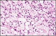 Soft tissue perineurioma with foci of spindle cells with wavy nuclei and an admixture of myxoid and collagenous stroma 15.