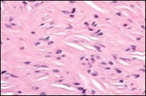 Soft tissue perineurioma with an abundance of collagen fibrils intermixed with a neural element with bipolar cells with elongated cytoplasm and wavy nuclei 16.