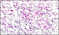 Soft tissue perineurioma with neural cells exemplifying elongated cytoplasmic processes, slender, wavy nuclei and an abundance of collagenous stroma 17.