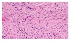 Soft tissue perineurioma with plentiful collagenous fibrils intermixed with lamellar neural tissue with elongated cytoplasmic extensions and wavy, pointed nuclei 18.