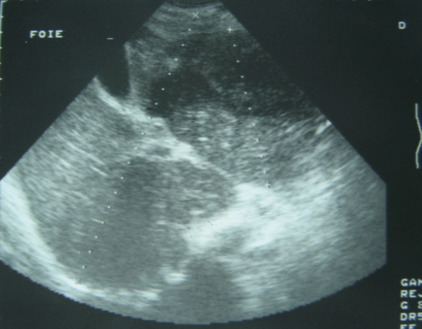Ultrasonography showing a 10 cm hypoechoic lesion