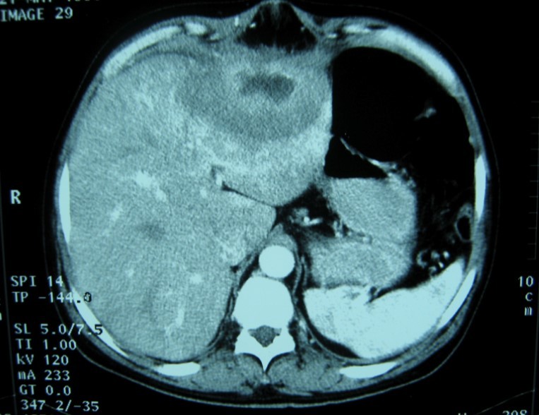 Abdominal computed tomography with intravenous contrast showing 10x7 cm low-density focal lesion
