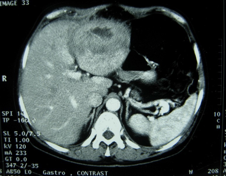 Abdominal computed tomography with intravenous contrast showing the lesion with ring enhancement.