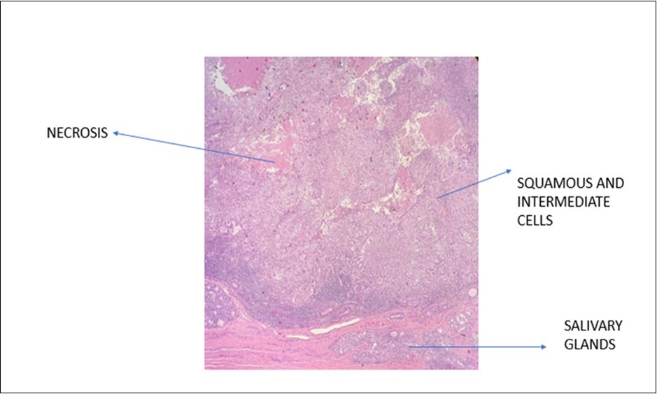 Photomicrograph show presence of squamous and intermediate cells in MEC of larynx (x20 high power field)