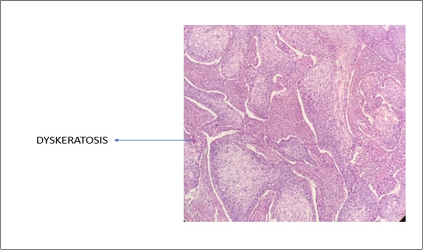 Photomicrograph show presence of dyskeratotic cells in SCC of parotid (x40 high power field)