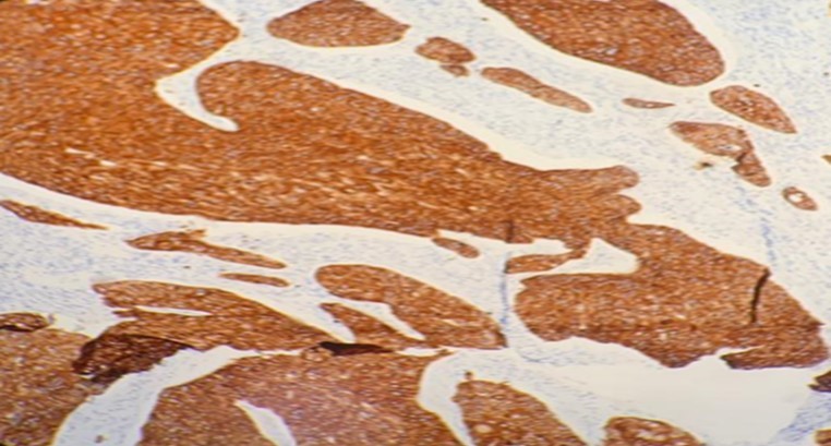 Photomicrograph show positivity to immunohistochemistry marker CK 5/6 in SCC of parotid (x20 high power field)