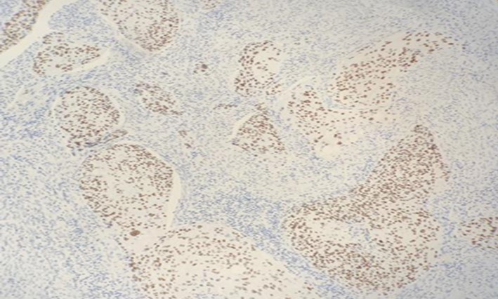 Photomicrograph show positivity to immunohistochemistry marker p40(nuclear) in SCC of parotid (x20 high power field)