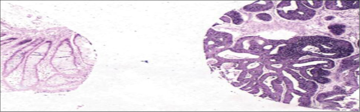 Differential expression of miR-21 in colon cancer versus the adjacent normal tissue. In situ hybridization analysis for miR-21 in this core tissue microarray sample showed very high expression in the cytoplasm of cancer dells (right part of the image) and very low expression in the adjacent normal colonic tissue epithelia (left part of image). The signal is blue due to nitroblue tetrazolium and bromochlorindol phosphate and counterstaining with nuclear fast red, x10 67.