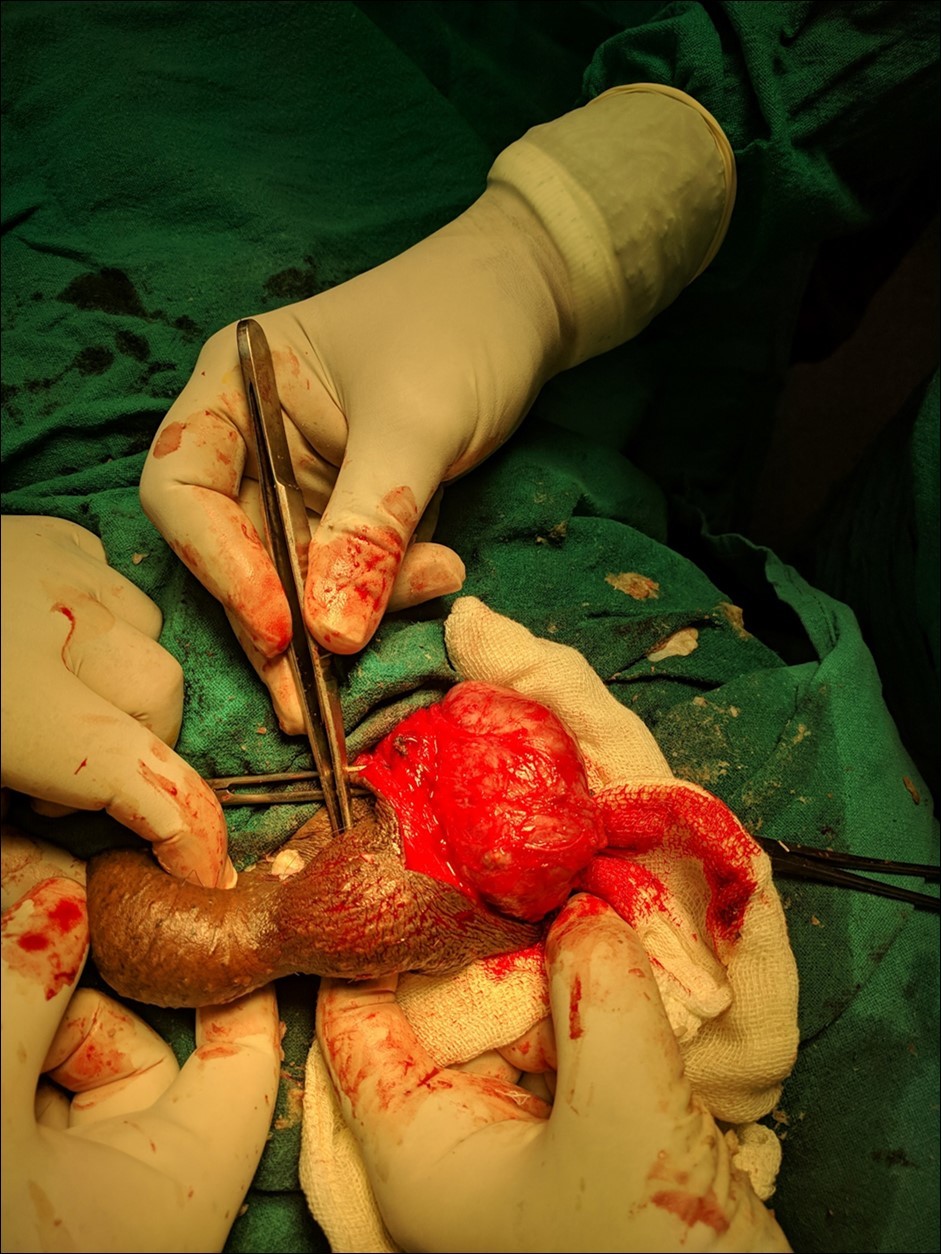 Operative picture showing testis separate from cyst