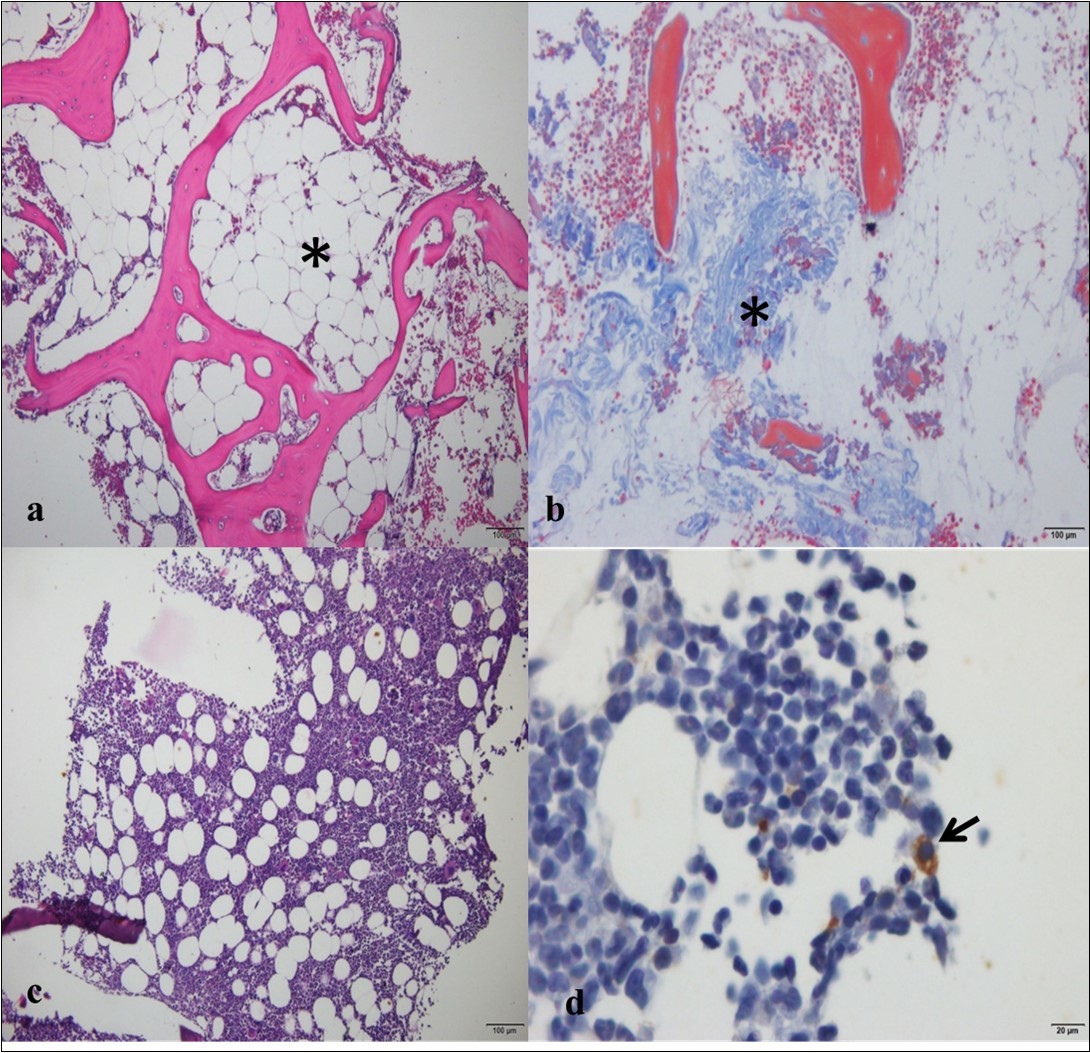 Photomicrographs of the bone marrow of a female dog with a mammary tumor. a) Note severe hypocellularity and predominance of adipose tissue (*), in a female dog positive for Ehrlichia canis (bar = 100 µm; hematoxylin and eosin). b) Note the proliferation of fibrous tissue (*) in the bone marrow (bar = 100 µm; Masson’s trichrome). c) Note the normocellular bone marrow in the analysis on the biopsy (bar = 100 µm; hematoxylin and eosin). d) Same animal as in C, showing an epithelial cell positive for cytokeratin-19 (arrow; bar = 20 µm; peroxidase-linked polymer complex).