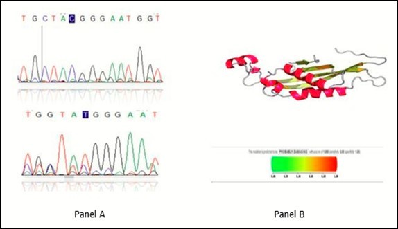 Chromatogram of mutation of 200C>T on the lower part of panel A with wild type in lower part. Panel B represents the 3D structure in upper region and pathogenicity degree in the lower region A 200C>T mutation previously published. Polyphen2 data shows the mutation is probably damaging with score of 0.995 (sensitivity 0.99 specificity 0.99)