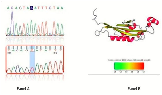 Chromatogram of novel mutations. Panel A sequence analysis of A>T 86 mutation in the lower part of panel A to compare with wild type sequence in the upper part. 3D structure of mutated protein in upper region and pathogenicity of the mutation by polyphen2. The probability is benign with score of 0.001 (sensitivity 0.99 and specificity 0.95)