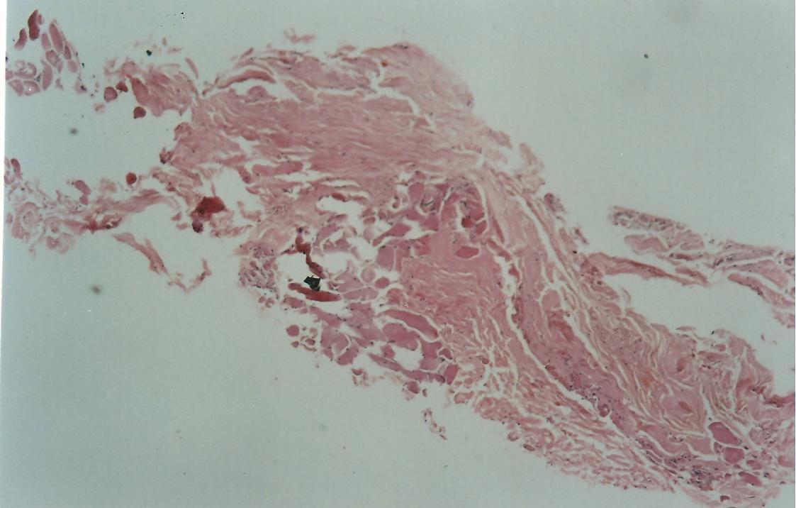 Fig x40, HE: Shows skeletal muscle on lower left and fibrocollagenous tissue of fascia on upper right