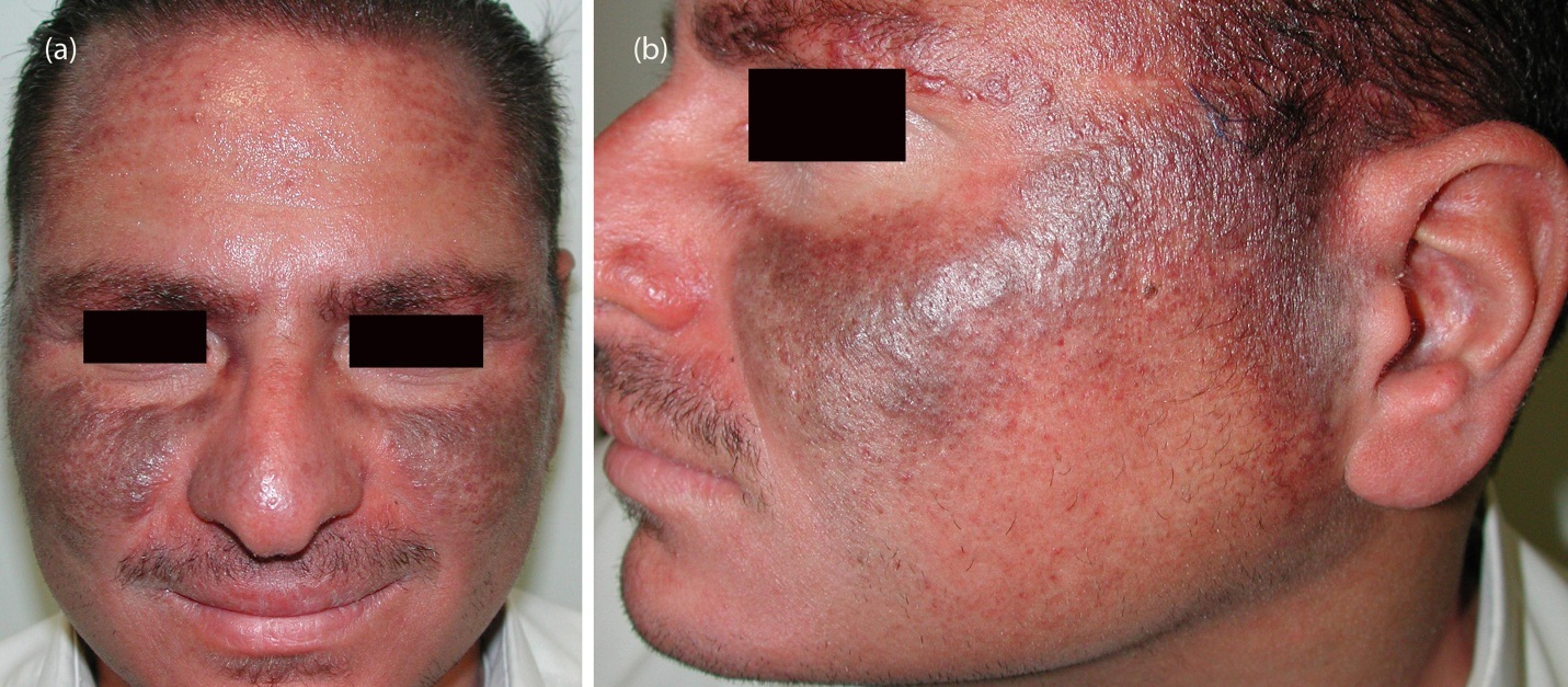 (a) and (b) Increased facial pigmentation manifesting as well-demarcated hyperpigmented patches and plaques on an erythematous purpuric background predominantly in sun-exposed areas.