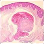 Papillary endothelial hyperplasia exemplifying papillary configuration with endothelial cell layering and a superimposed stratified squamous epithelial lining 12.