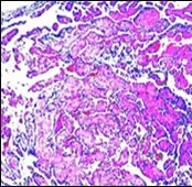Papillary endothelial hyperplasia enunciating papillary arrangements coated with single layer of endothelial cells intermingled with significant fibrinous and thrombotic exudate13.