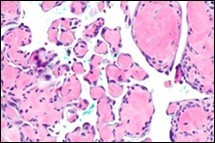 Papillary endothelial hyperplasia exhibiting papillary configurations lined with single endothelial cell layer and lack of significant atypia 14.