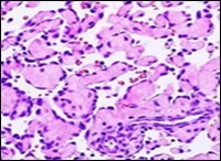 Papillary endothelial hyperplasia delineating papillary articulations layered with a single endothelial cell layer and an admixed fibrinous exudate 15.