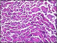 Papillary endothelial hyperplasia demonstrating significant papillary architecture, a single lining of endothelial cells intermixed with fibrinous and thrombotic substances and lack of atypia 16.