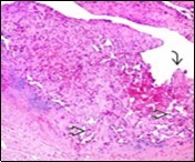 Papillary endothelial hyperplasia depicting papillae layered with a single endothelial layer, absence of atypia and fibrinous, thrombotic material 17.
