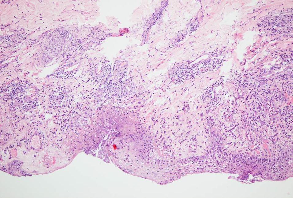 Histopathology of a laser and imiquimod treated basal cell carcinoma at the end of the study (day 20).Focal epidermal necrosis with moderate granulocytic demarcation and reactive perivascular lymphocytic and eosinophilic infiltrates. No residual neoplastic proliferates (HE, x200).