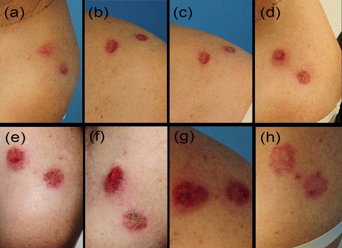 Sequence of the typical therapeutic skin reactions in an arm 3 basal cell carcinoma patient at all visits: Days 0, 2, 4, 7, 9, 11, 13, 20 (a-h)