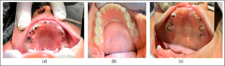 Example pre-treatment intraoral images for Ecuador (a), Ghana (b), and Bolivia (c) at initial evaluation.