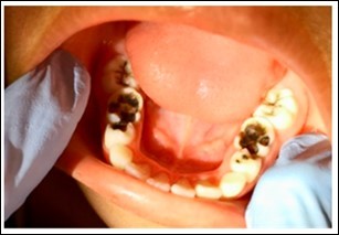 Example intraoral image of arrested cavitated caries lesions ost treatment.