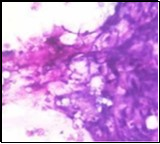 Parachordoma on fine needle aspiration cytology depicting clusters of spheroidal cells with eosinophilic cytoplasm, regular nuclei and clumped, encompassing myxoid stroma 13.