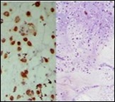 Parachordoma delineating clusters of vacuolated, spherical cells with acidophilic cytoplasm, uniform nuclei and an immune non reactive CD34- 13.